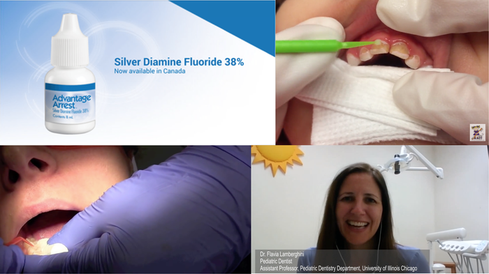 Discover Silver Diamine Fluoride through experts' videos